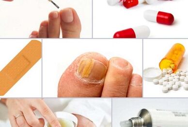 Cómo tratar el hongo en las uñas