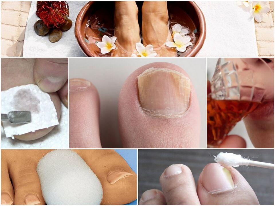Tratamiento de hongos de uñas