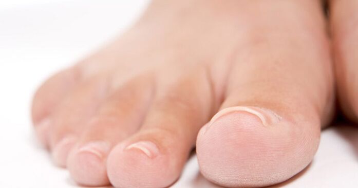 Las uñas de los pies pueden verse afectadas por una infección por hongos